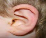 ear infection