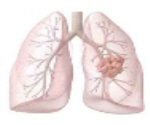 lungcancer